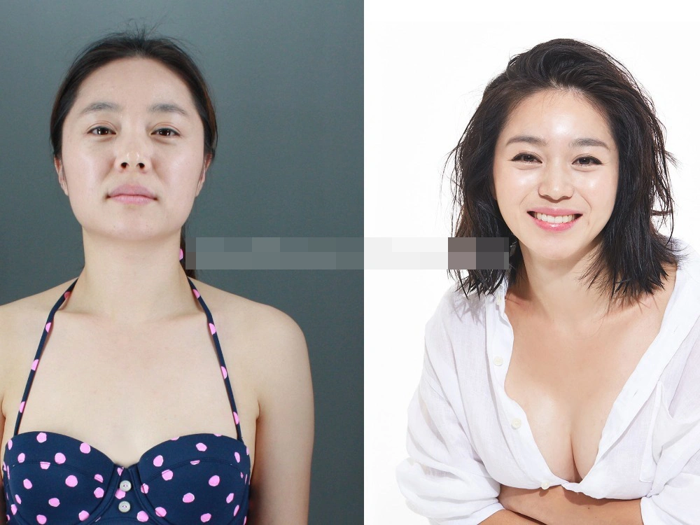 Manufacturer Non-Crosslinked/Crosslinked Hyaluronic Acid Breast Enhancement Cream 1ml Filler